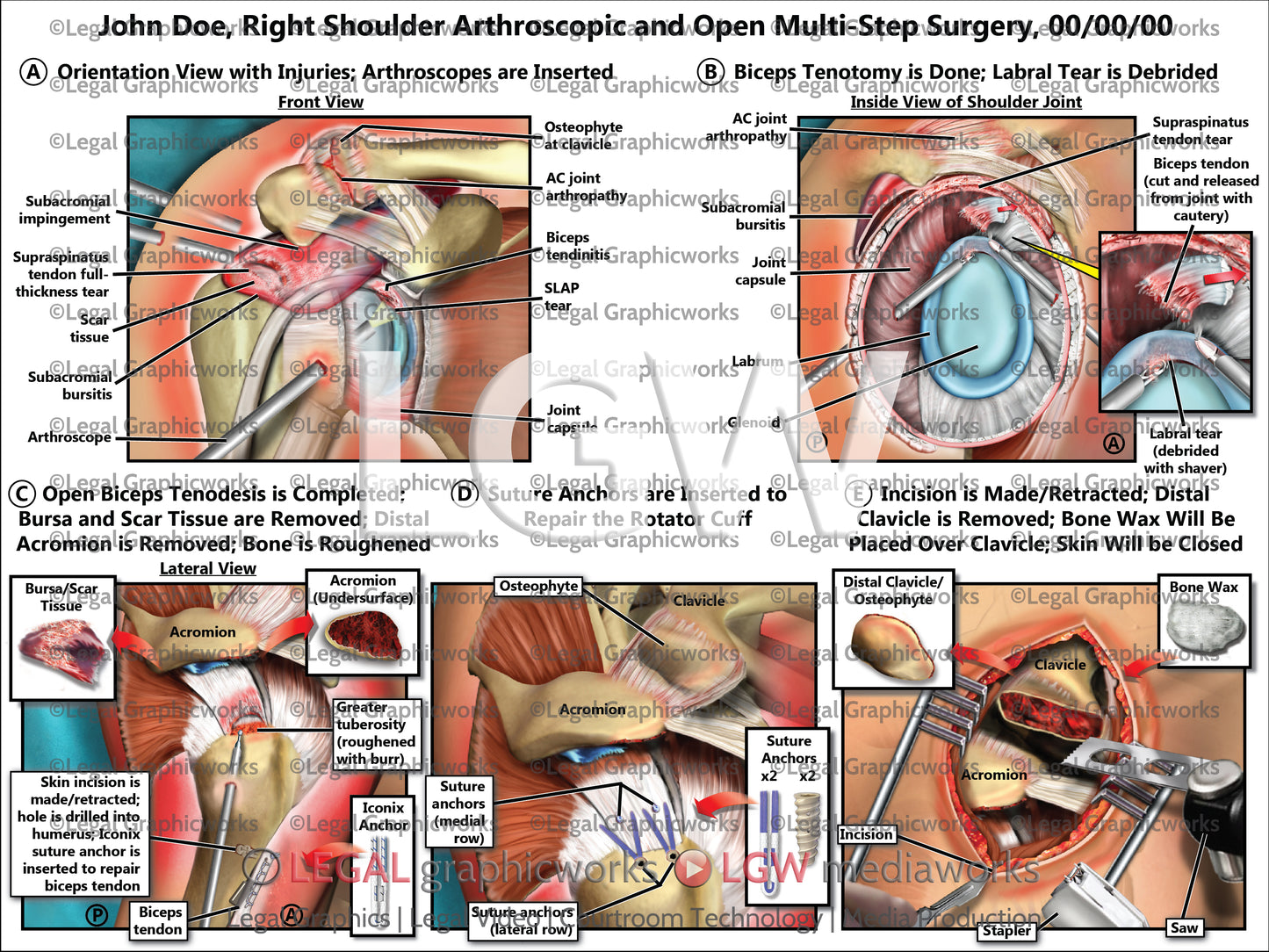 Right Shoulder Arthroscopic and Open Multi-Step Surgery