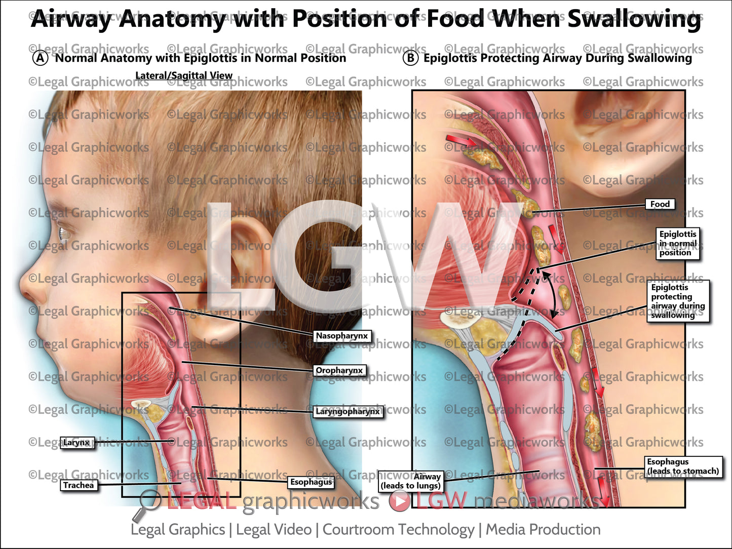 Airway Anatomy with Position of Food When Swallowing