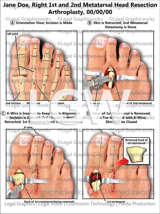 Right 1st and 2nd Metatarsal Head Resection Arthroplasty