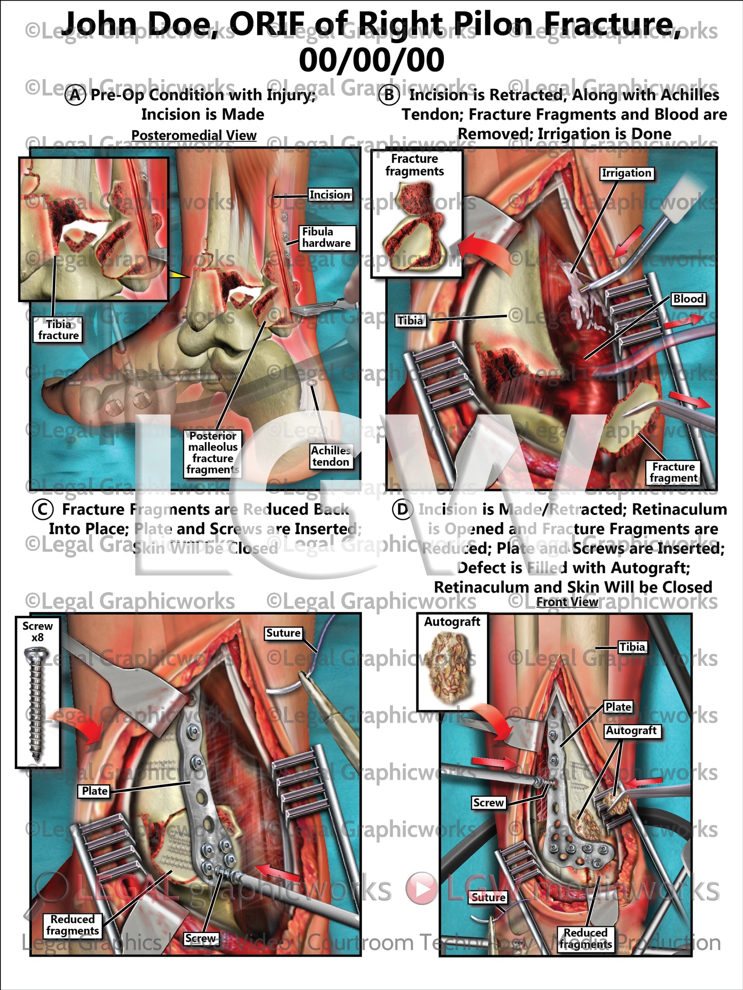 ORIF of Right Pilon Fracture