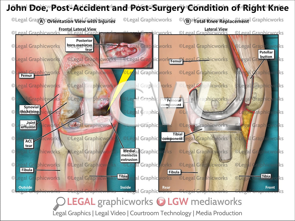 Post-Accident and Post-Surgery Condition of Right Knee