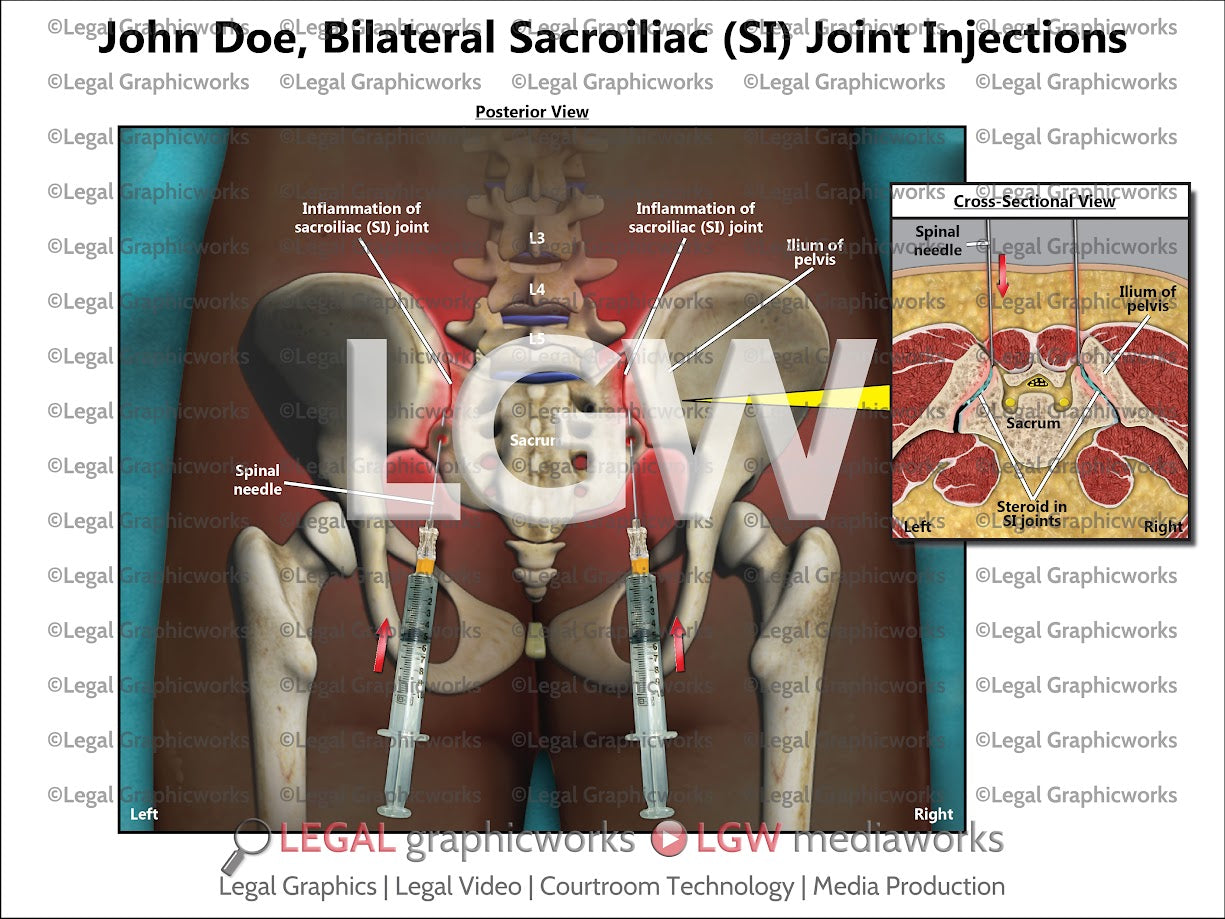 Bilateral Sacroiliac (SI) Joint Injections