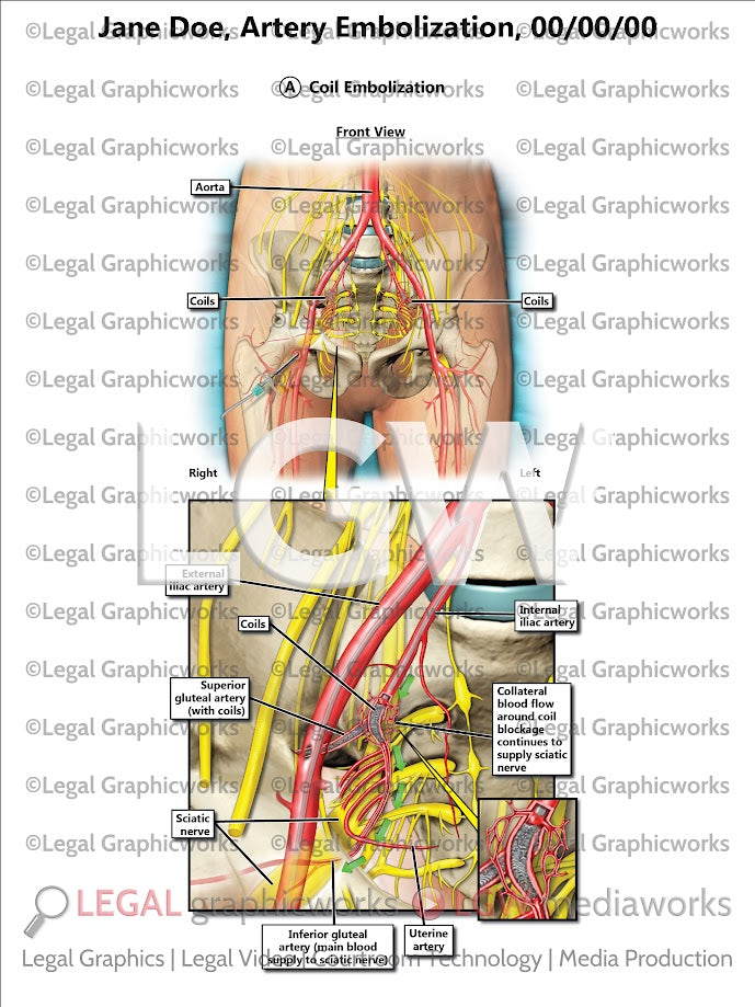 Artery Embolization
