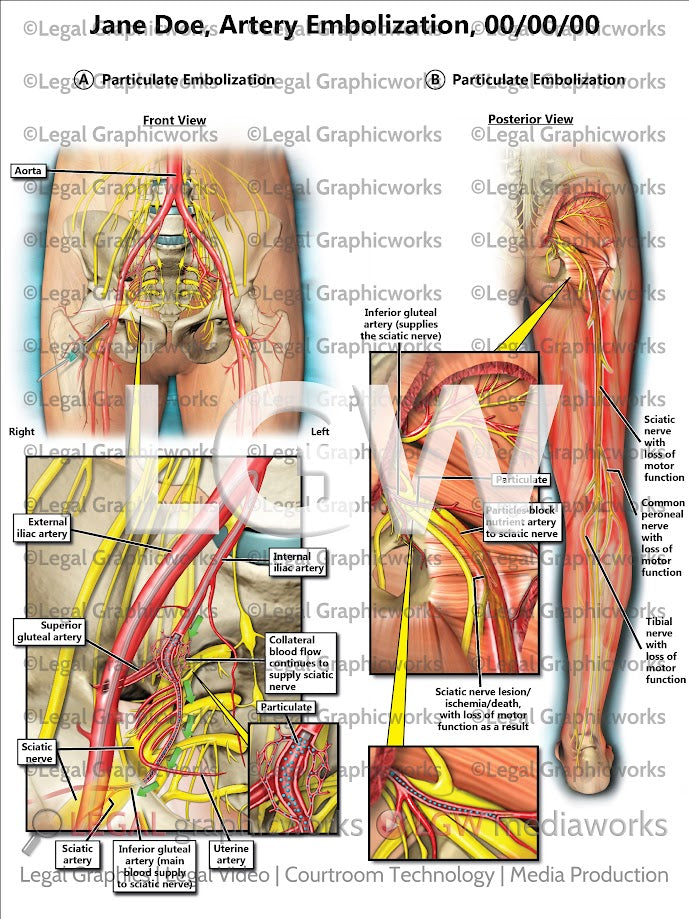 Artery Embolization