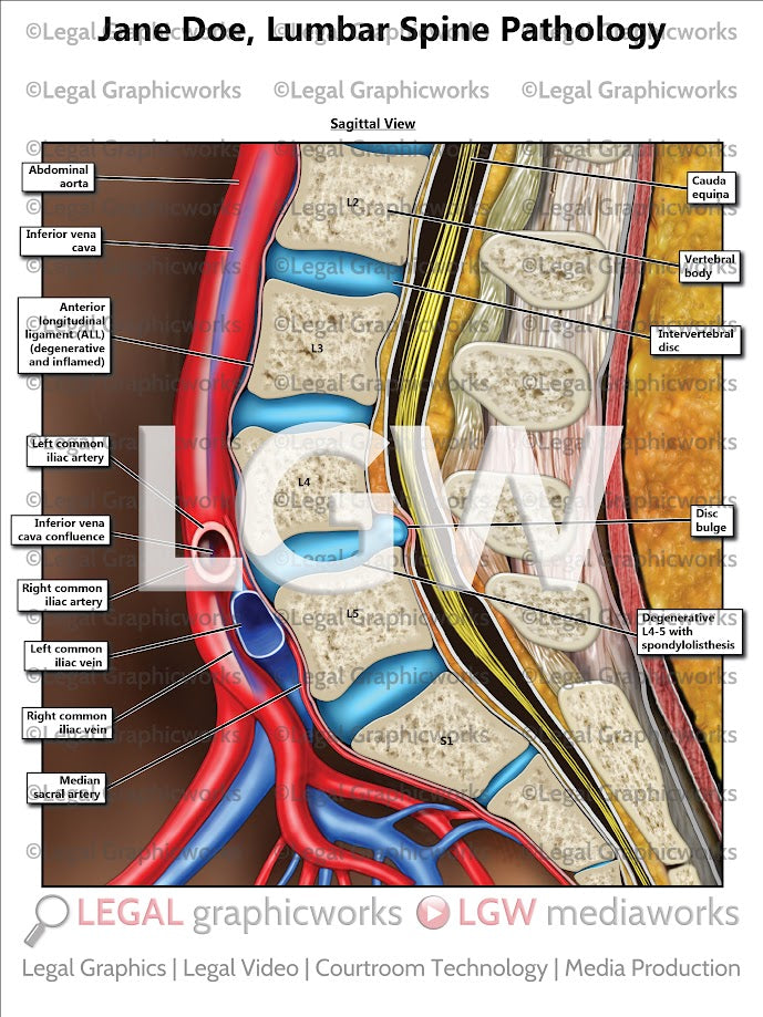 Lumbar Spine Pathology