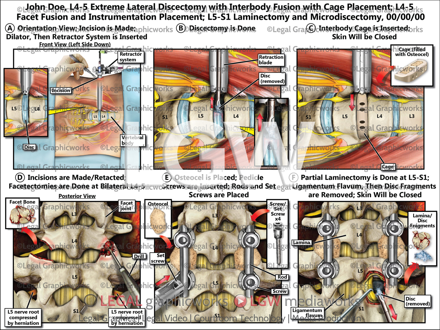 L4-5 Extreme Lateral Discectomy with Interbody Fusion with Cage Placement; L4-5 Facet Fusion and Instrumentation Placement; L5-S1 Laminectomy and Microdiscectomy
