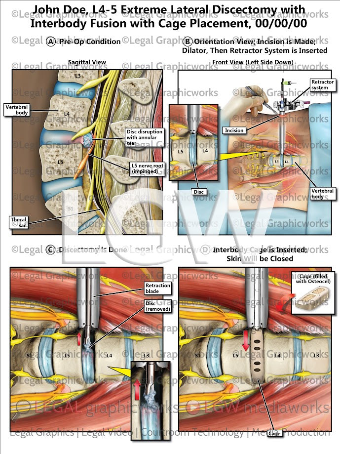 L4-5 Extreme Lateral Discectomy with Interbody Fusion with Cage Placement