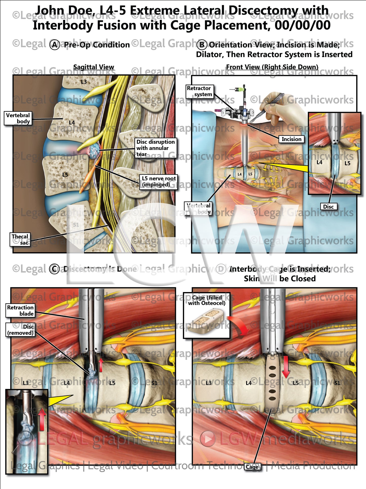 L4-5 Extreme Lateral Discectomy with Interbody Fusion with Cage Placement
