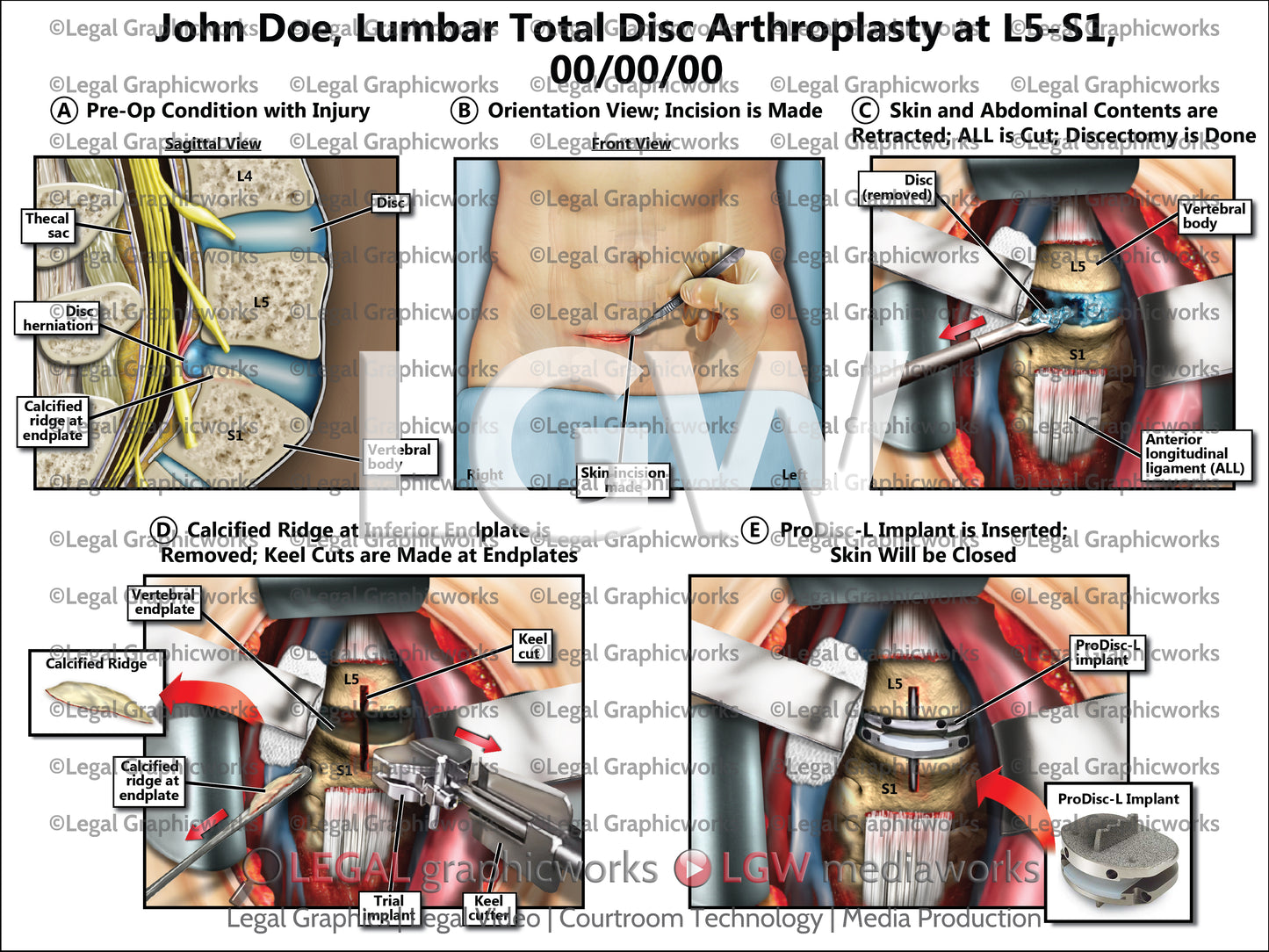 Lumbar Total Disc Arthroplasty at L5-S1
