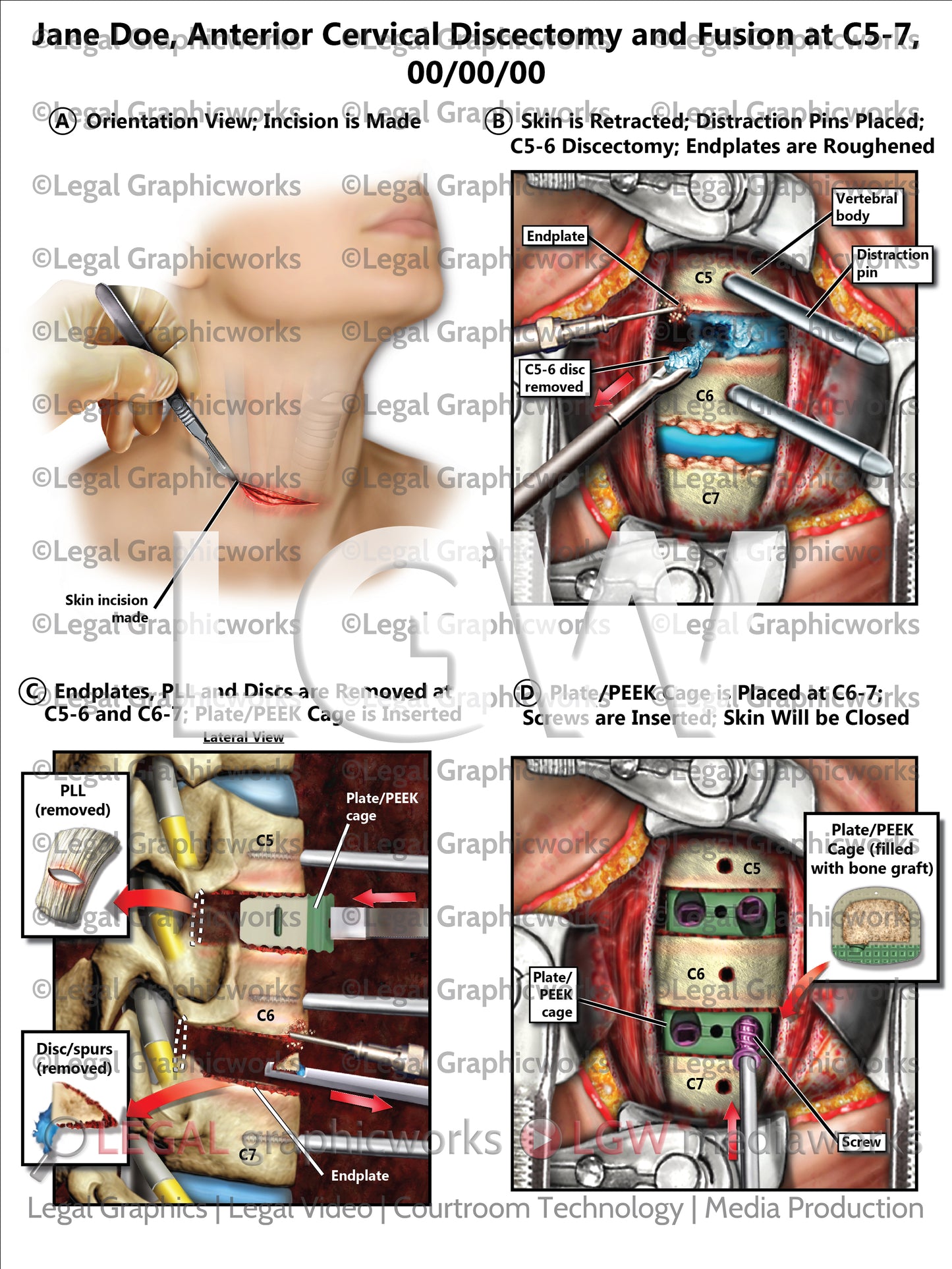 Anterior Cervical Discectomy and Fusion at C5-7