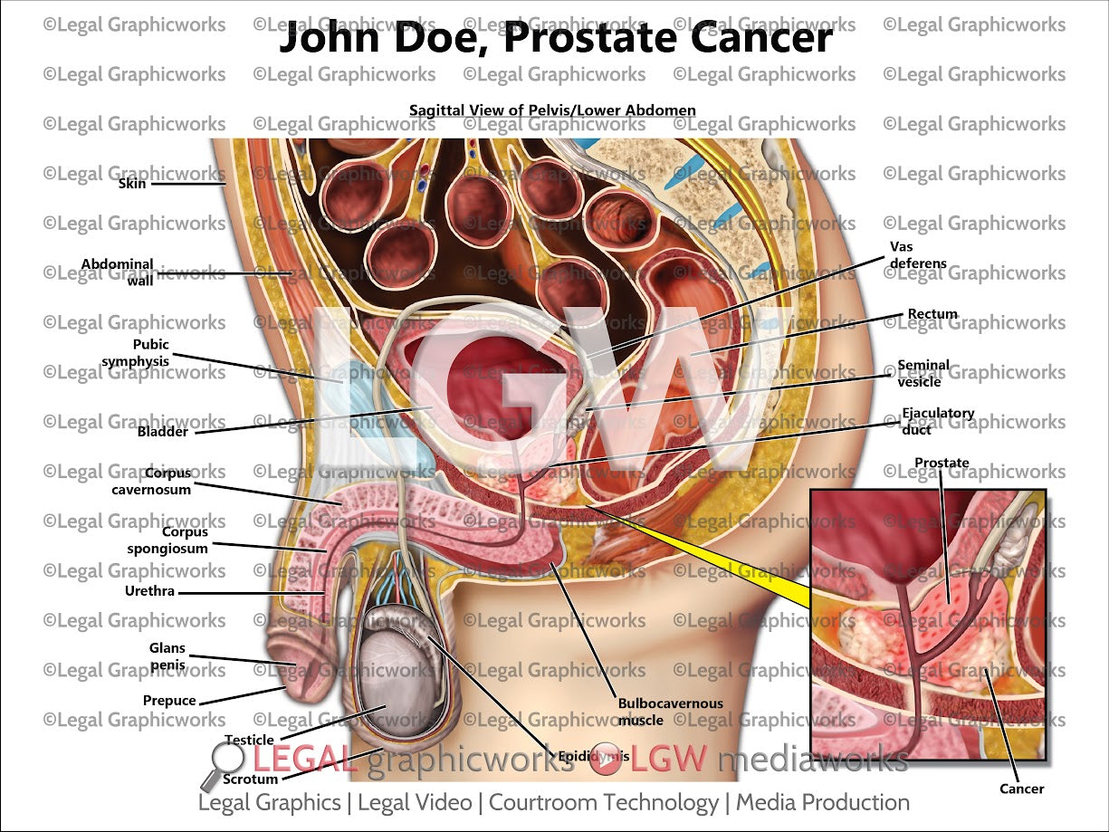 Prostate Cancer
