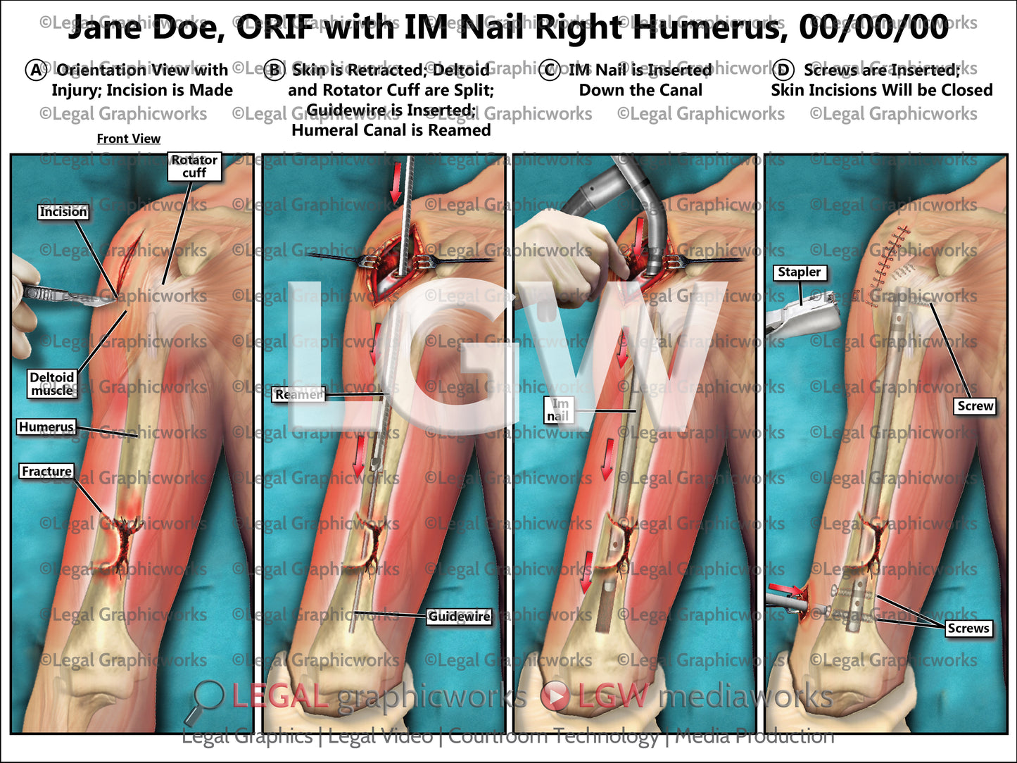 ORIF with IM Nail Right Humerus