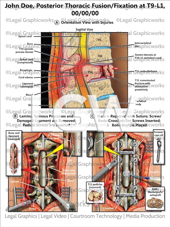 Posterior Thoracic Fusion/Fixation at T9-L1