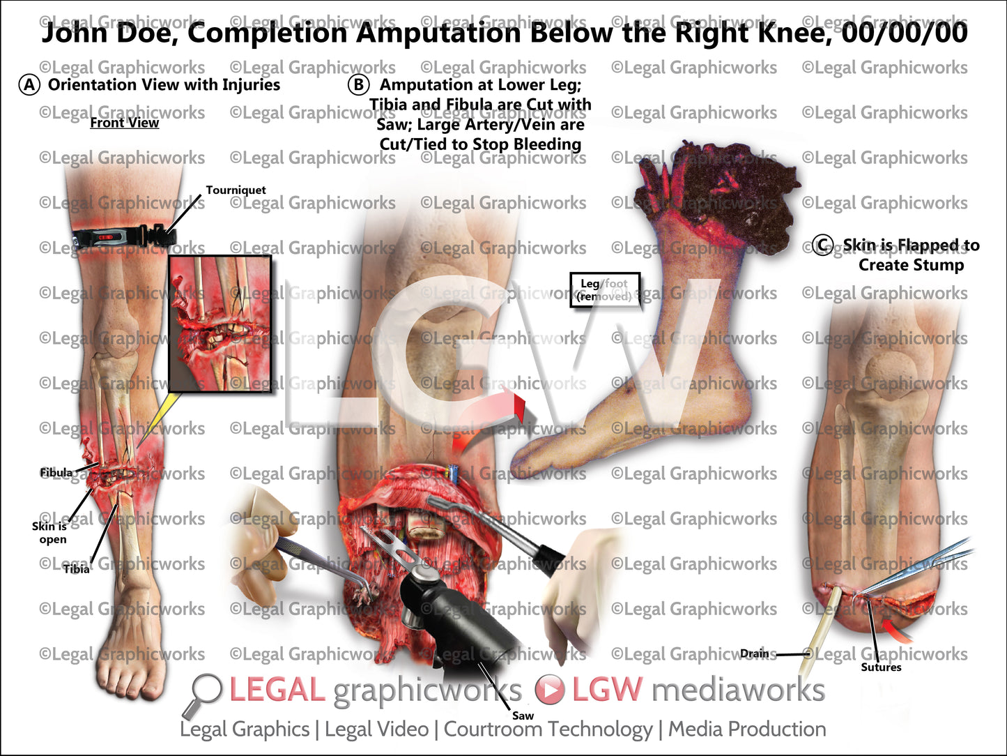 Completion Amputation Below the Right Knee