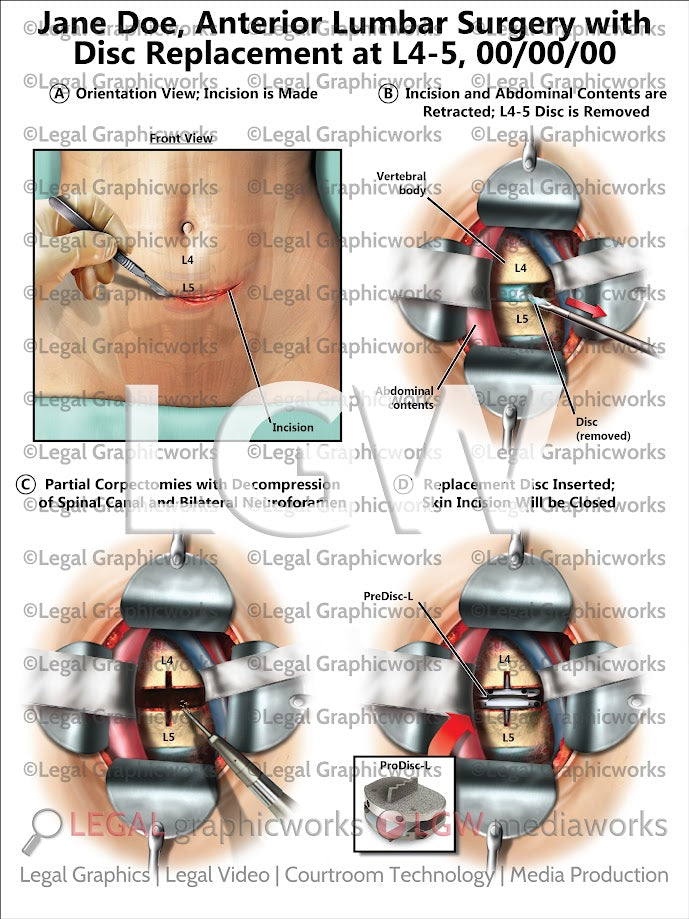 Anterior Lumbar Surgery with Disc Replacement at L4-5