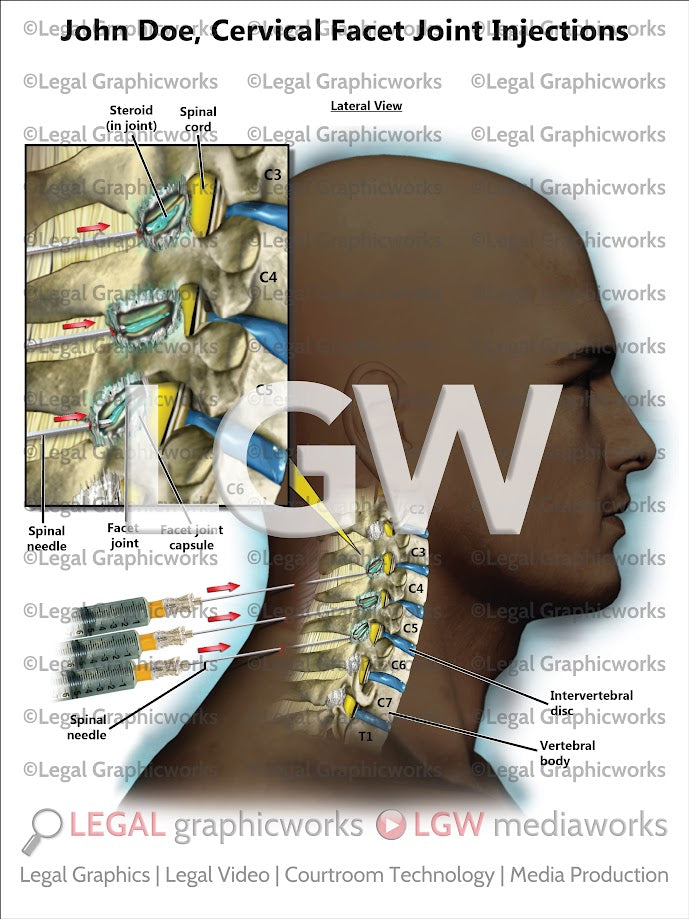 Cervical Facet Joint Injections