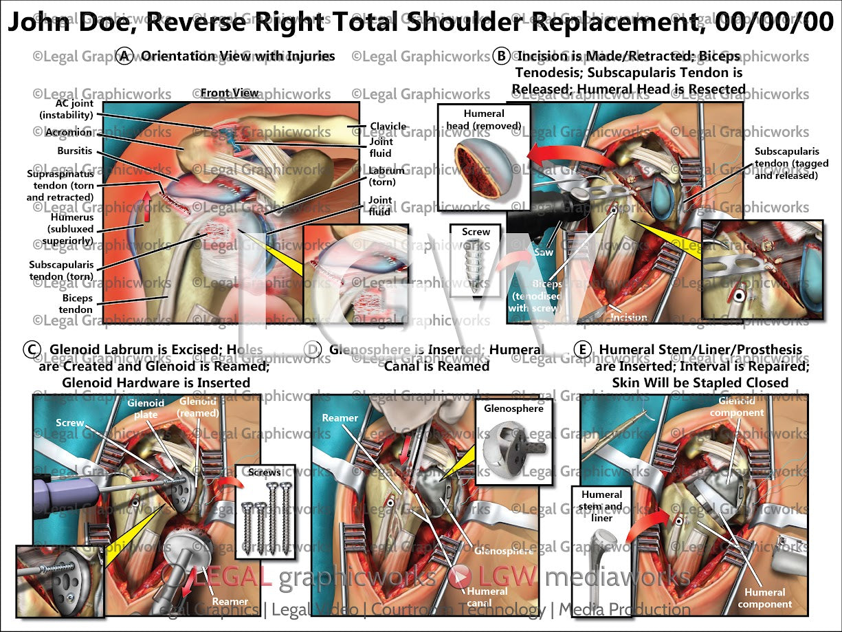 Reverse Right Total Shoulder Replacement
