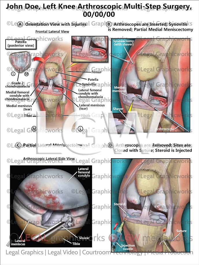 Left Knee Arthroscopic Multi-Step Surgery