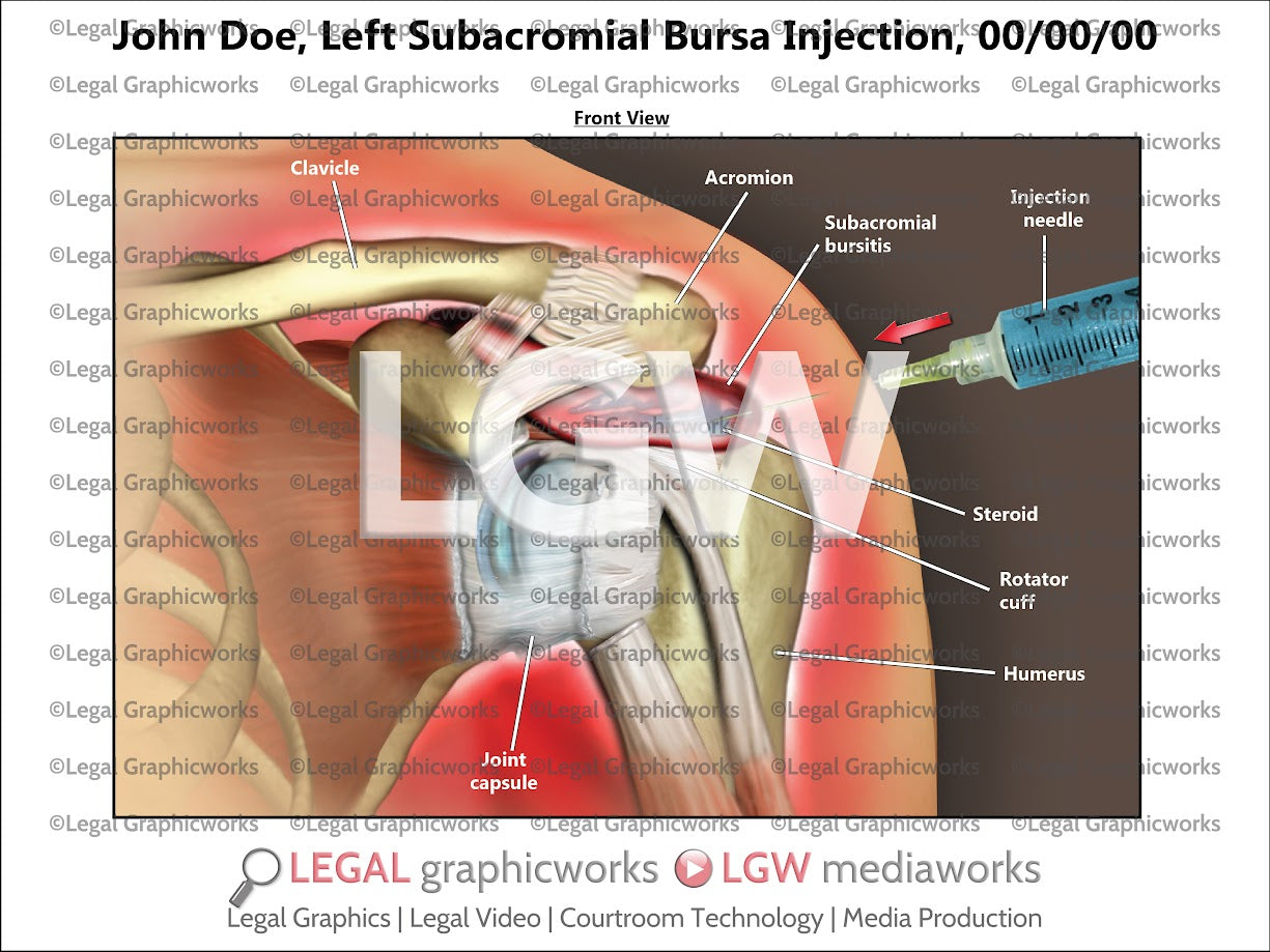 Left Subacromial Bursa Injection