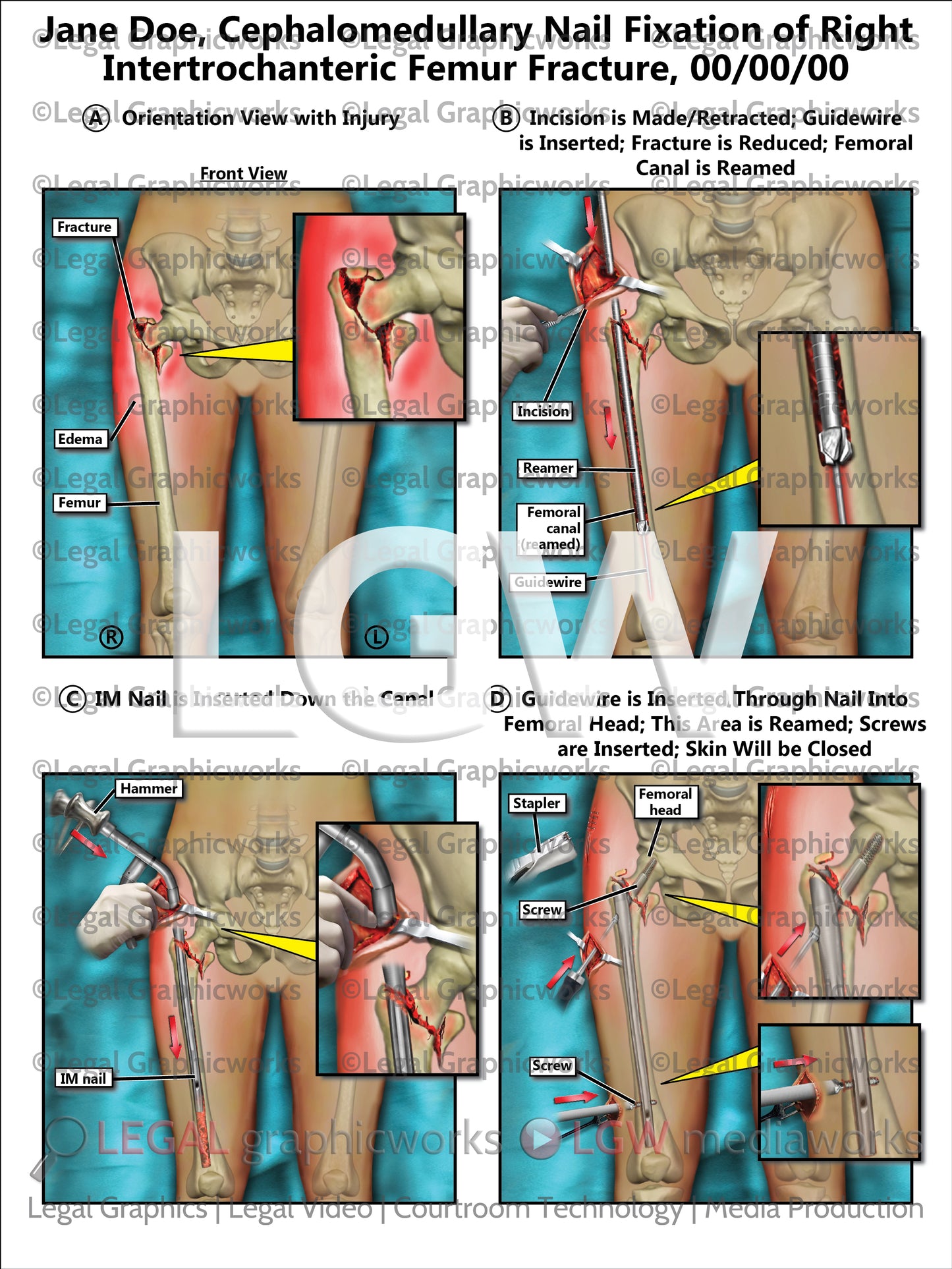 Cephalomedullary Nail Fixation of Right Intertrochanteric Femur Fracture