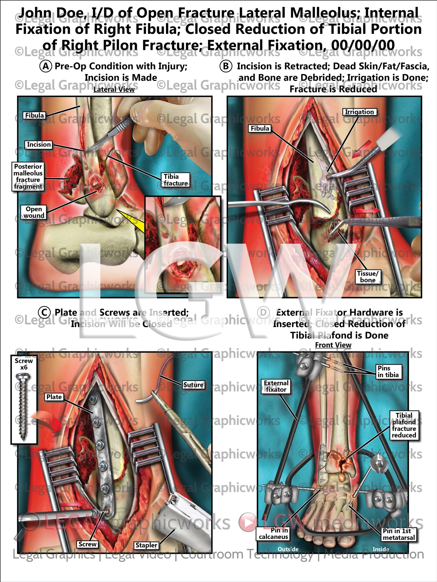 I/D of Open Fracture Lateral Malleolus; Internal Fixation of Right Fibula; Closed Reduction of Tibial Portion of Right Pilon Fracture; External Fixation