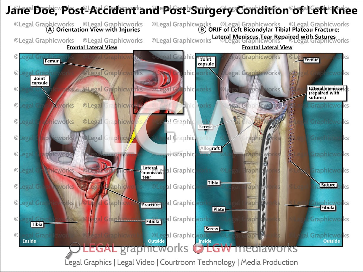 Post-Accident and Post-Surgery Condition of Left Knee