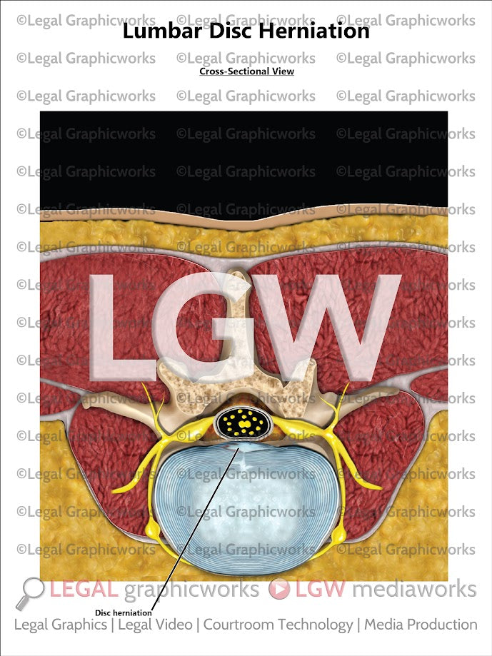 Lumbar Disc Herniation