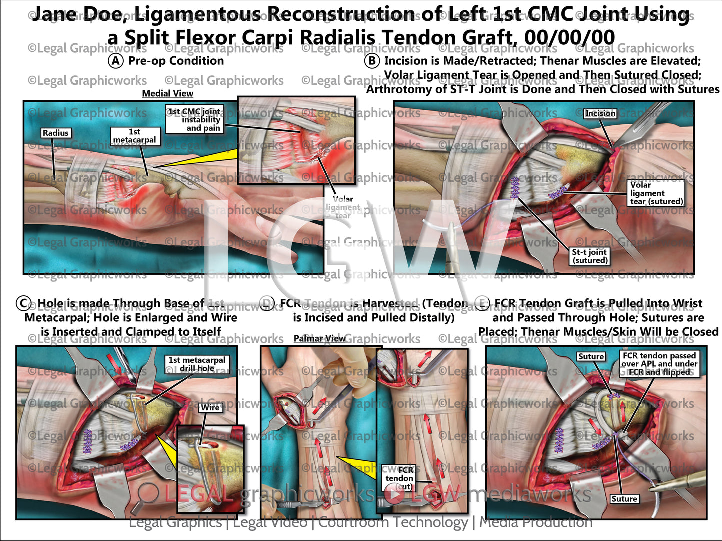 Ligamentous Reconstruction of Left 1st CMC Joint Using a Split Flexor Carpi Radialis Tendon Graft