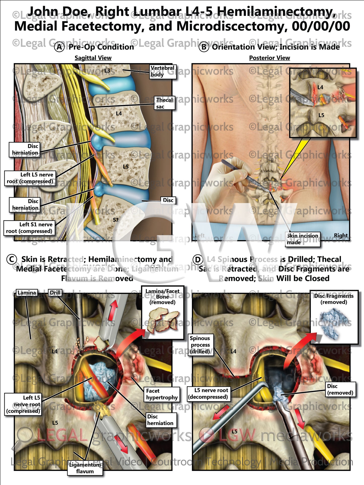 Right Lumbar L4-5 Hemilaminectomy, Medial Facetectomy, and Microdiscectomy