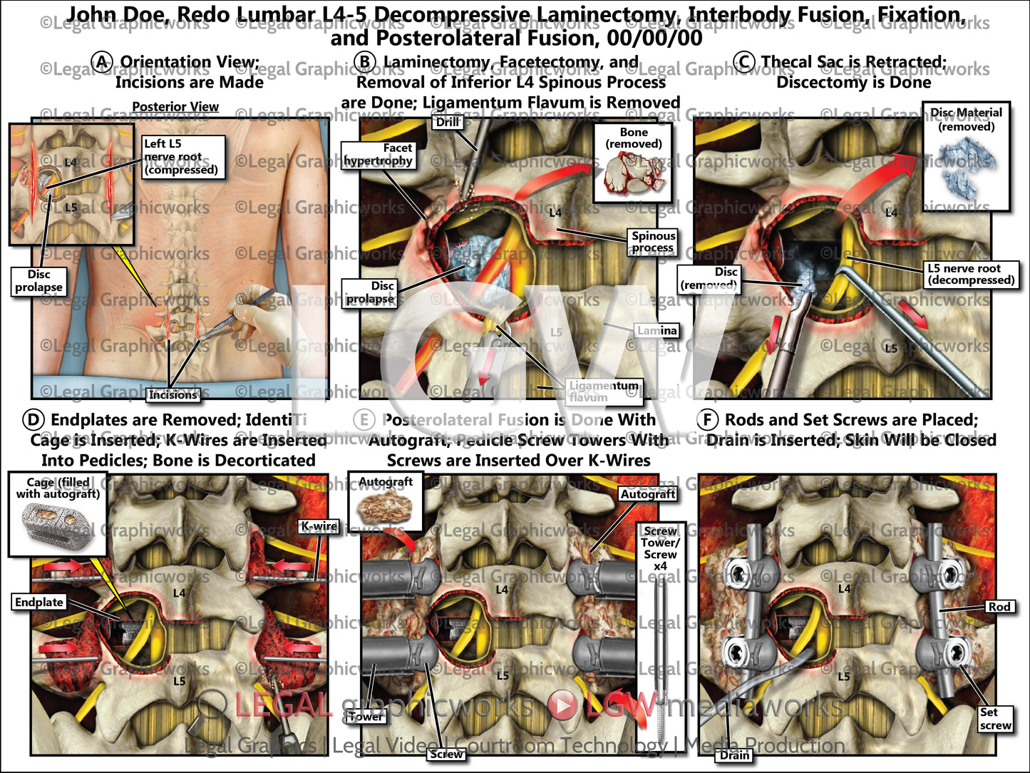 Redo Lumbar L4-5 Decompressive Laminectomy, Interbody Fusion, Fixation, and Posterolateral Fusion