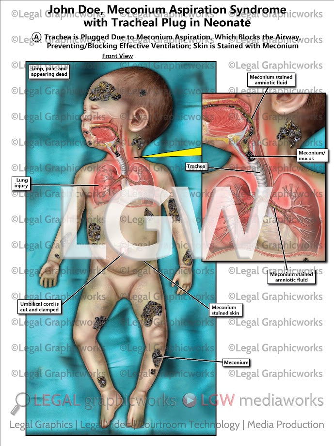 Meconium Aspiration Syndrome with Tracheal Plug in Neonate