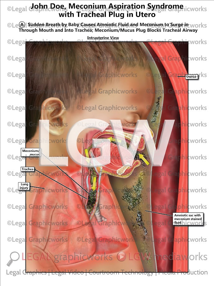 Meconium Aspiration Syndrome with Tracheal Plug in Utero