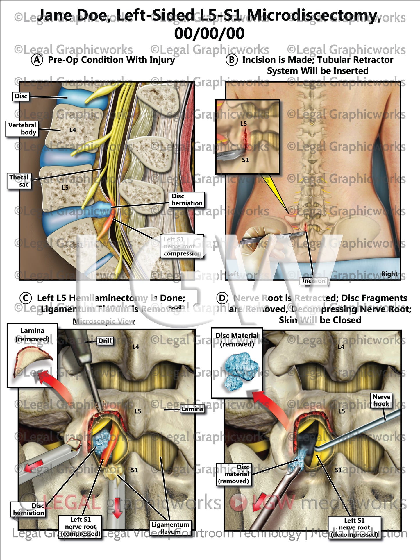 Left-Sided L5-S1 Microdiscectomy