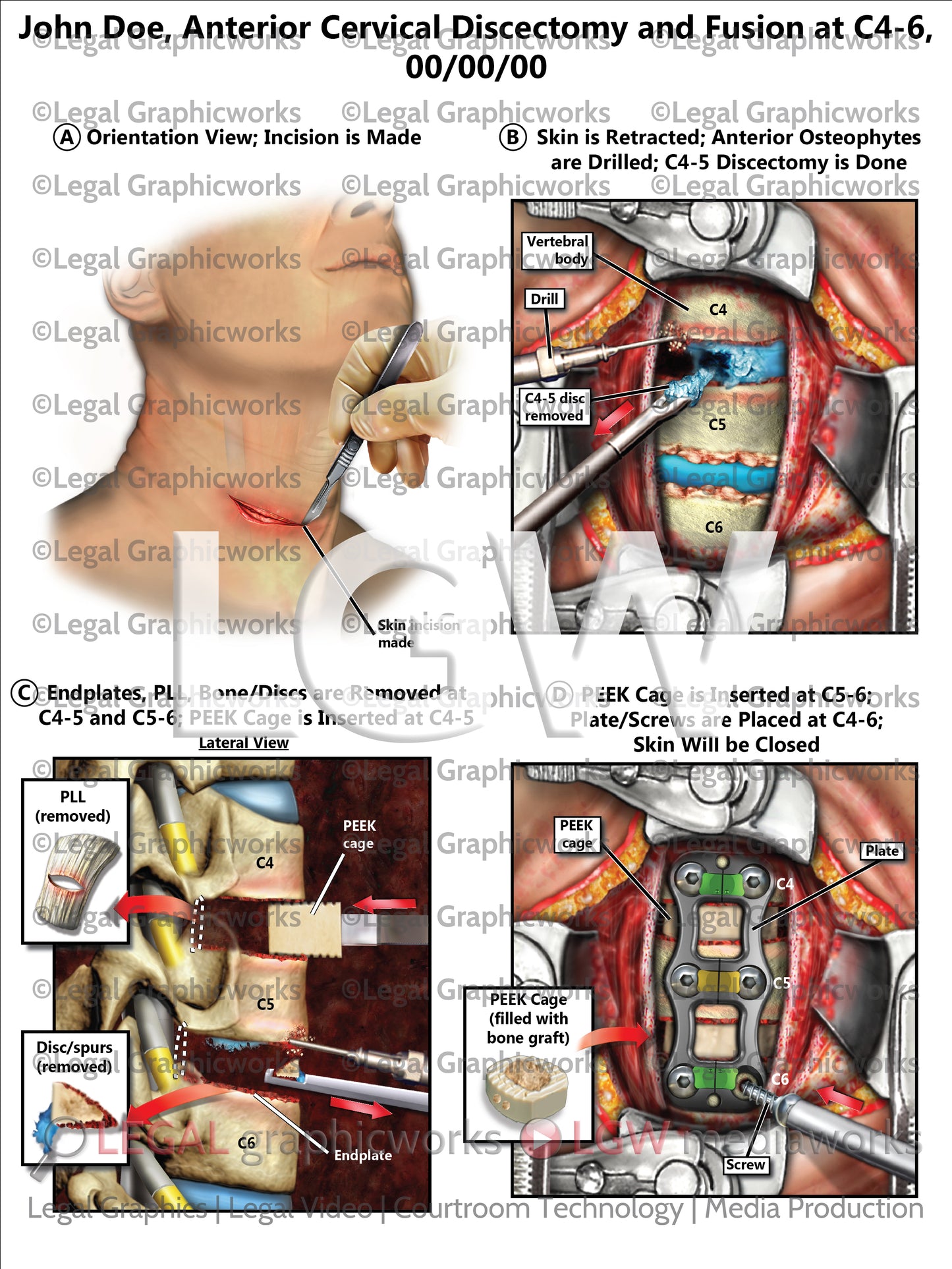 Anterior Cervical Discectomy and Fusion at C4-6