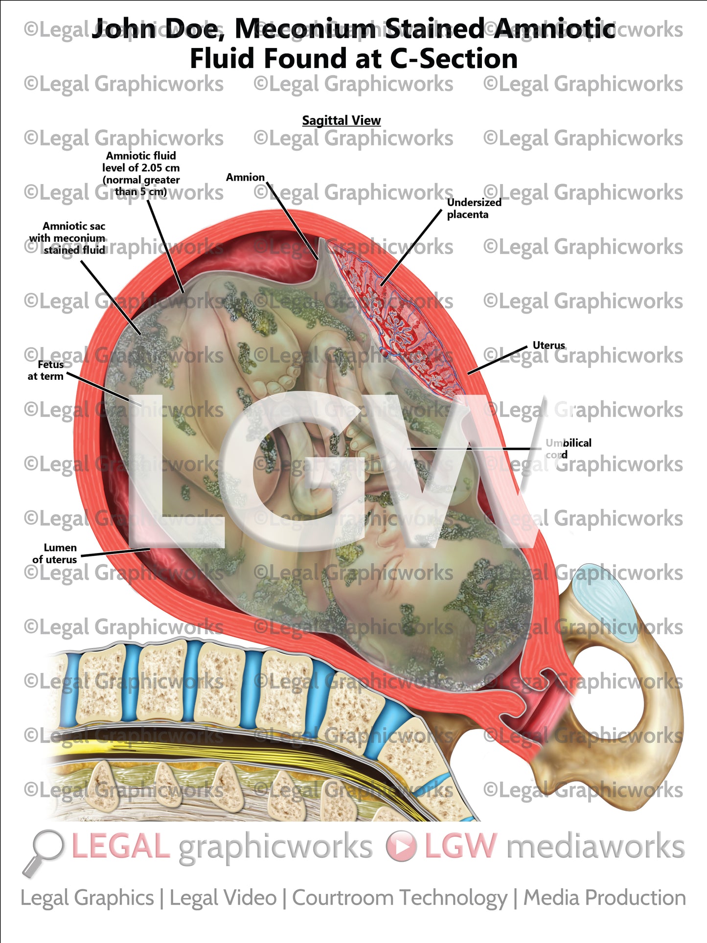 Meconium Stained Amniotic Fluid Found at C-Section