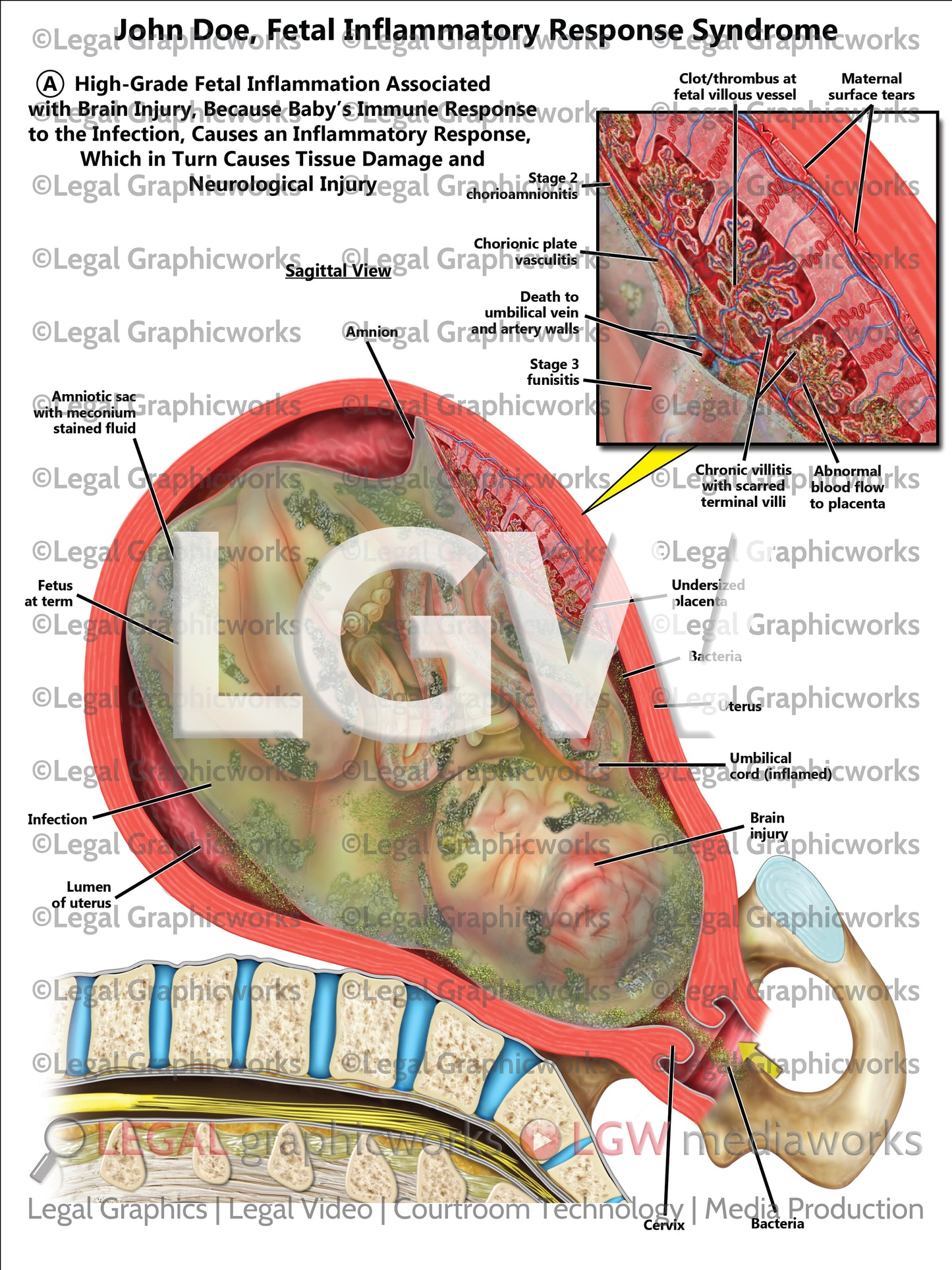 Fetal Inflammatory Response Syndrome