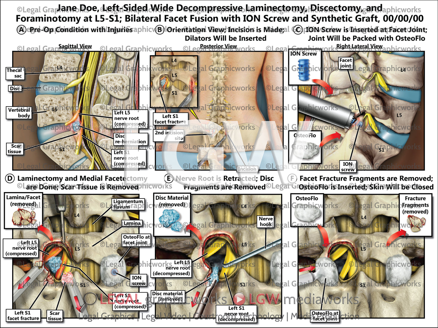 Left-Sided Wide Decompressive Laminectomy, Discectomy, and Foraminotomy at L5-S1; Bilateral Facet Fusion with ION Screw and Synthetic Graft