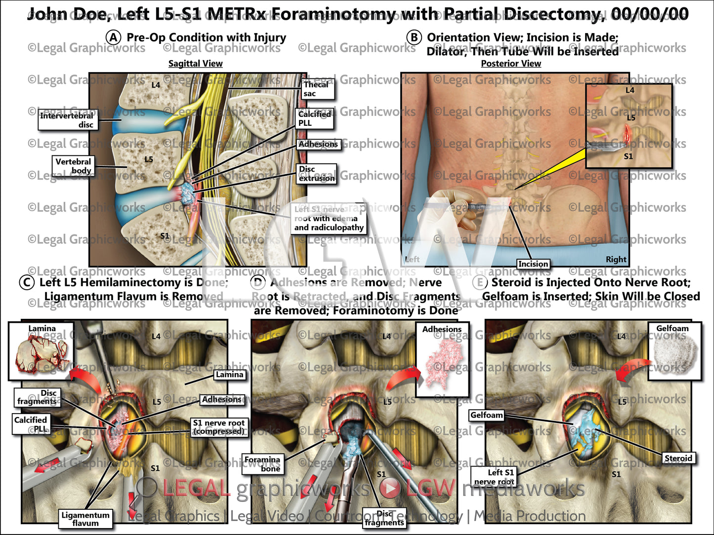 Left L5-S1 METRx Foraminotomy with Partial Discectomy