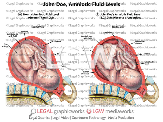 Amniotic Fluid Levels