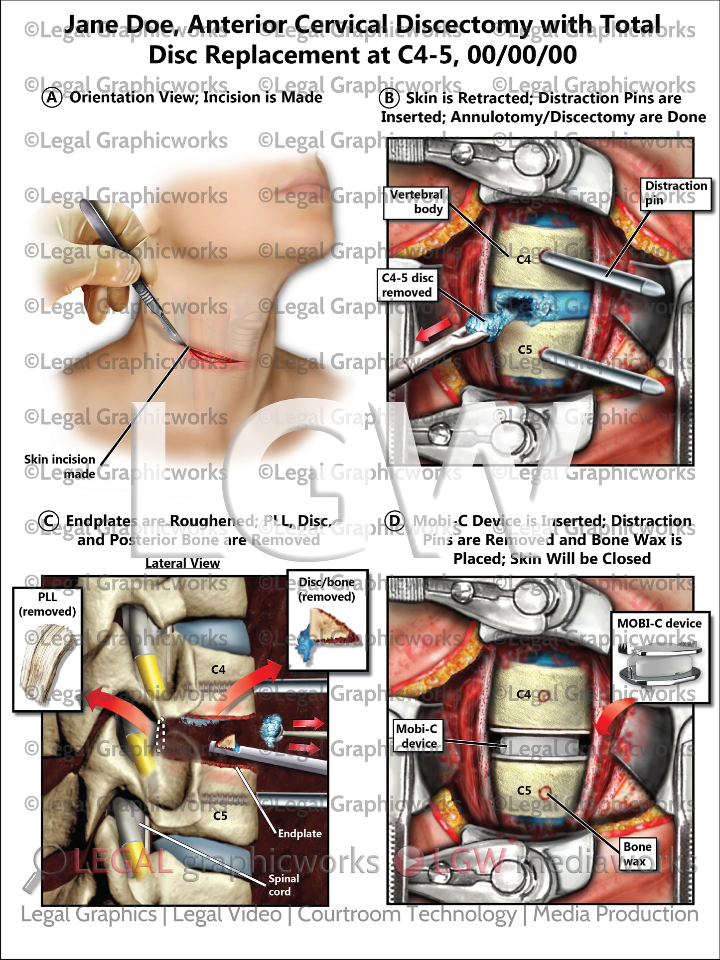 Anterior Cervical Discectomy with Total Disc Replacement at C4-5