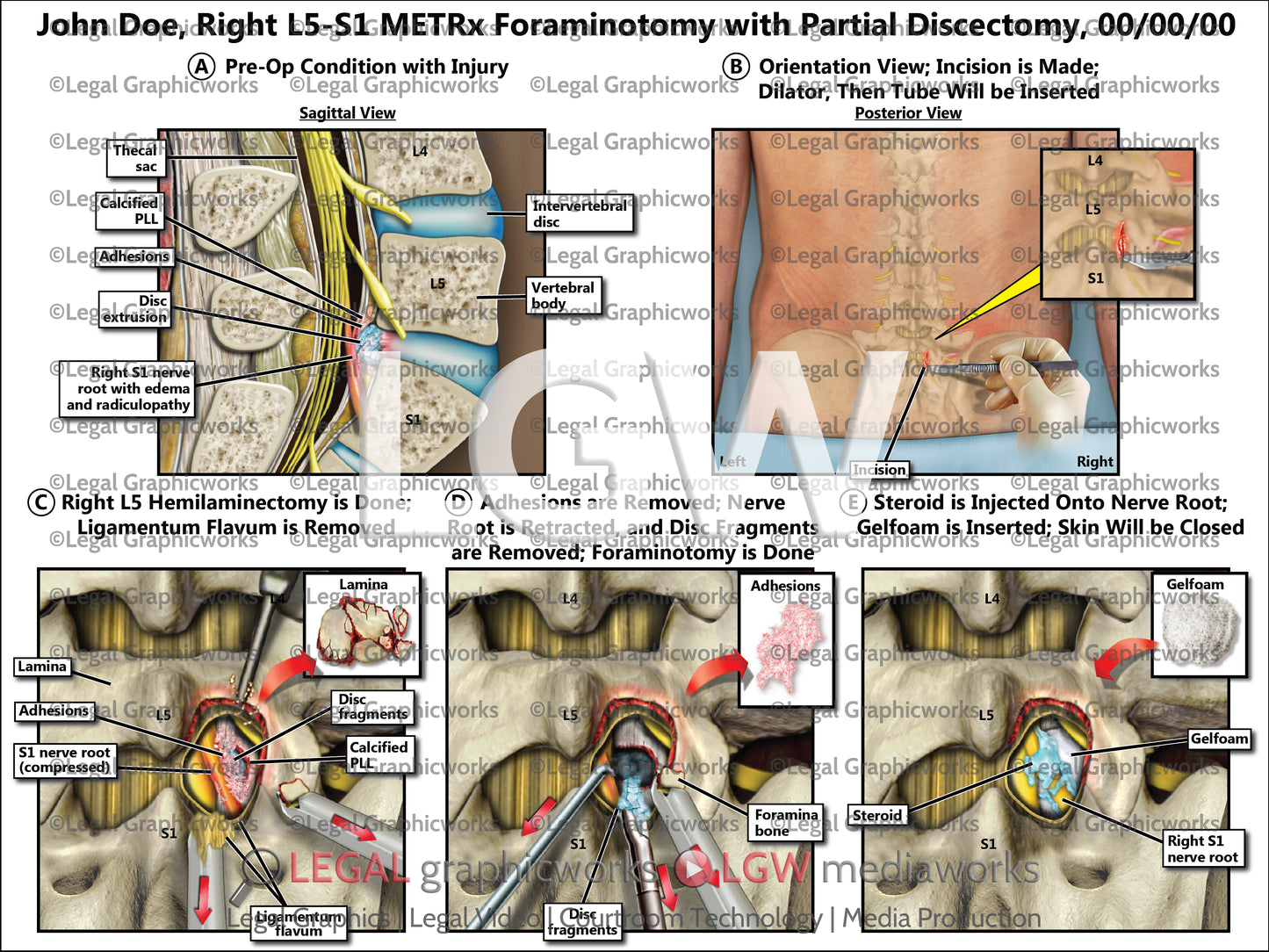 Right L5-S1 METRx Foraminotomy with Partial Discectomy