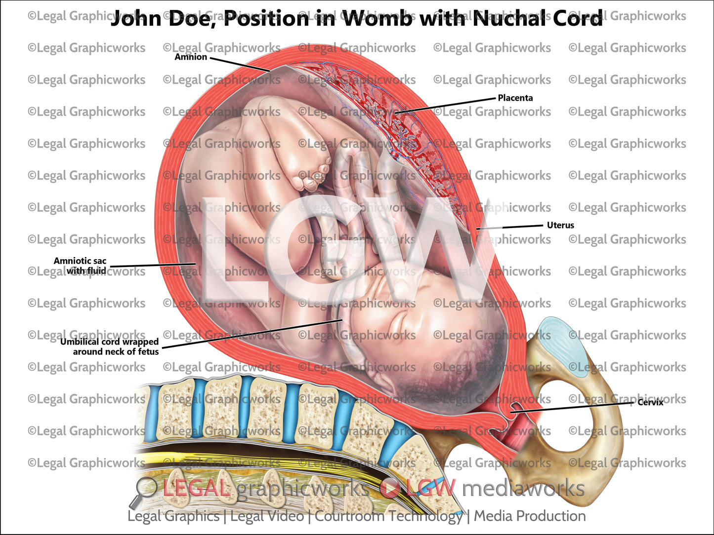 Position in Womb with Nuchal Cord