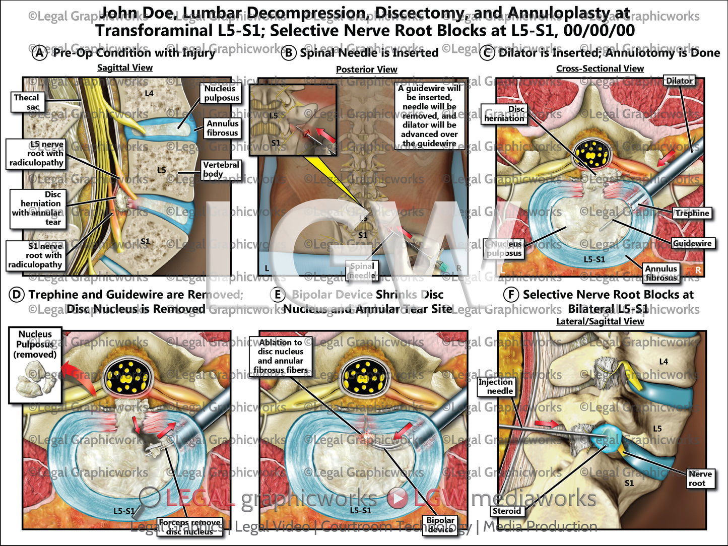 Lumbar Decompression, Discectomy, and Annuloplasty at Transforaminal L5-S1; Selective Nerve Root Blocks at L5-S1