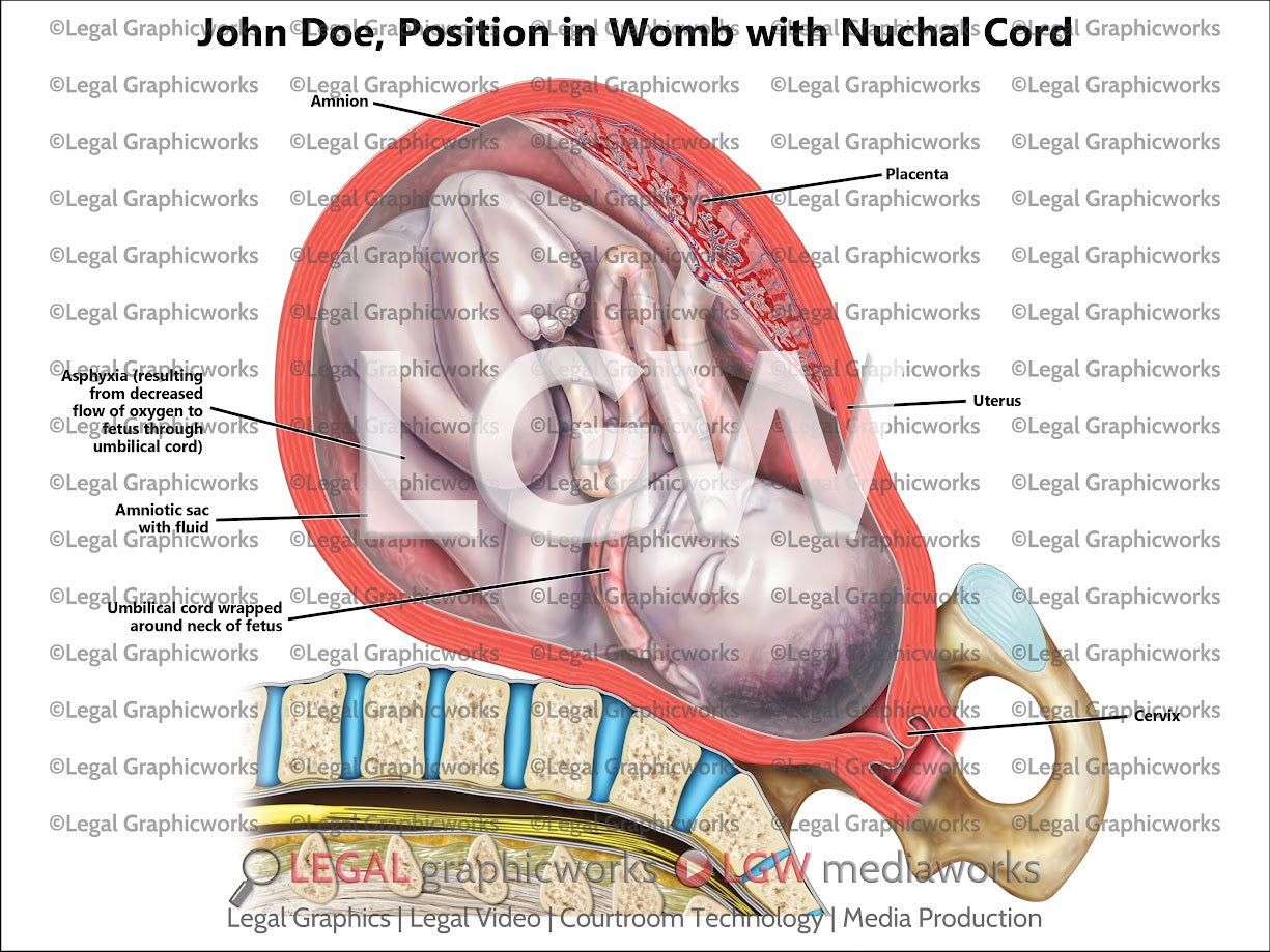 Position in Womb with Nuchal Cord