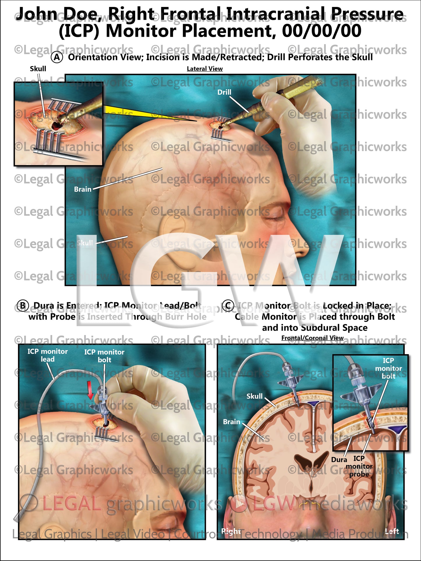 Right Frontal Intracranial Pressure (ICP) Monitor Placement