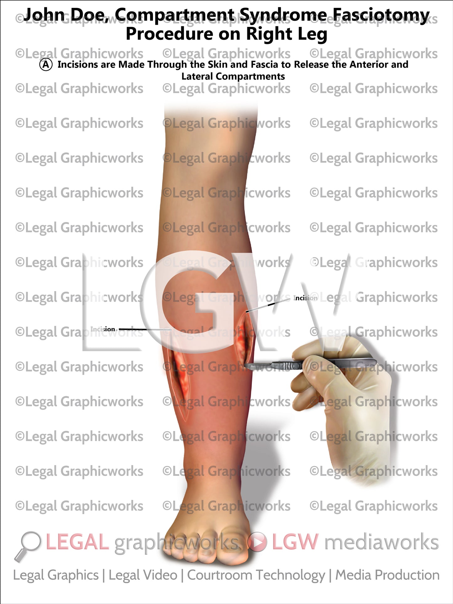 Compartment Syndrome Fasciotomy Procedure on Right Leg