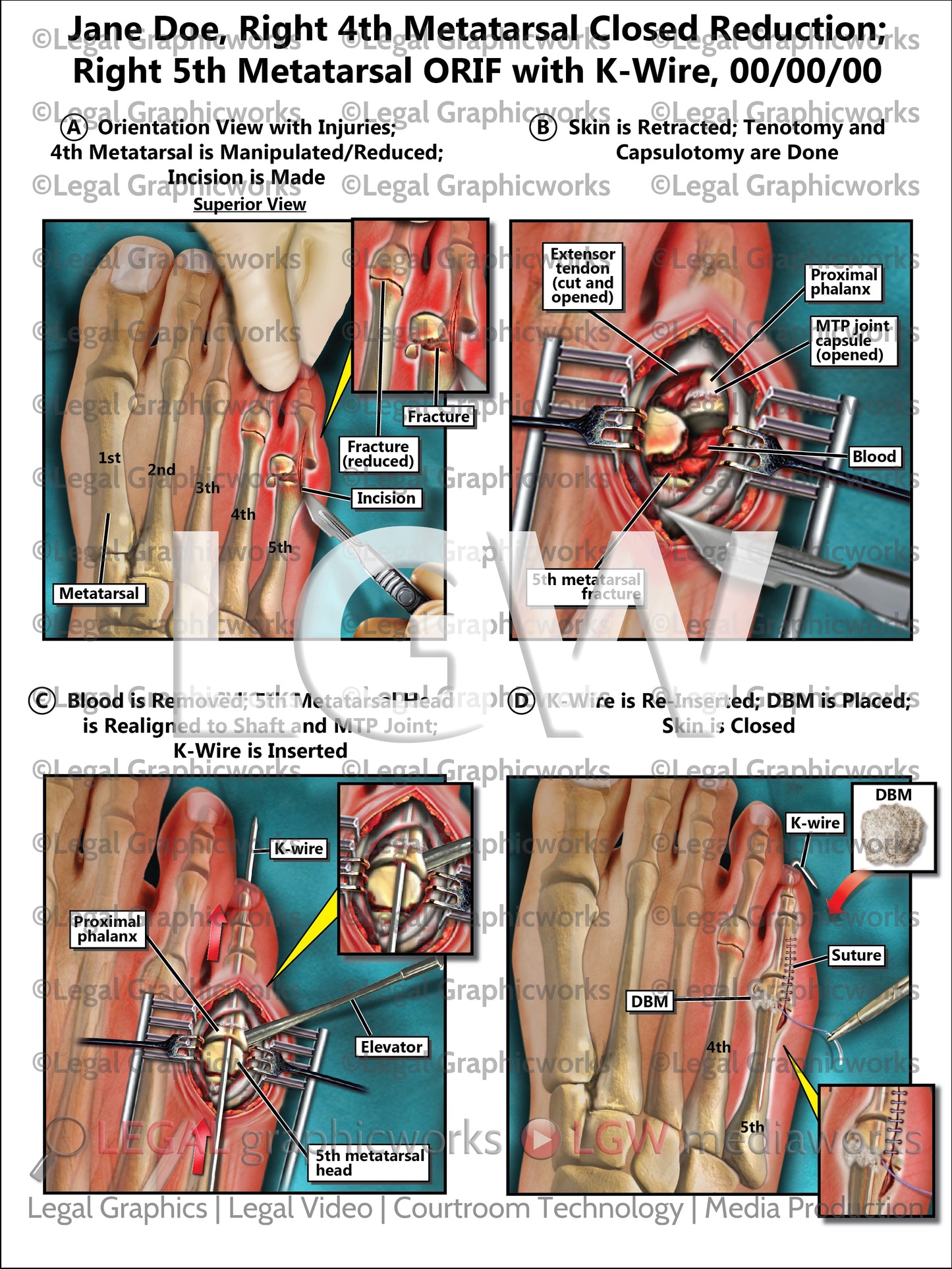 Right 4th Metatarsal Closed Reduction; Right 5th Metatarsal ORIF with K-Wire