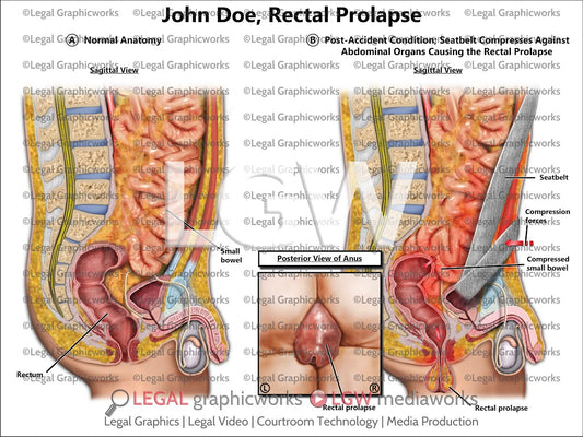 Rectal Prolapse
