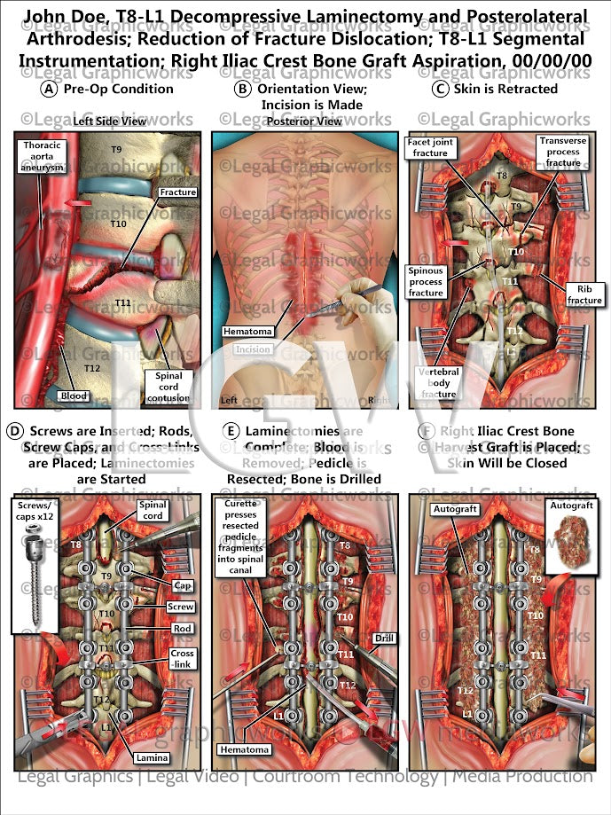 T8-L1 Decompressive Laminectomy and Posterolateral Arthrodesis; Reduction of Fracture Dislocation; T8-L1 Segmental Instrumentation; Right Iliac Crest Bone Graft Aspiration