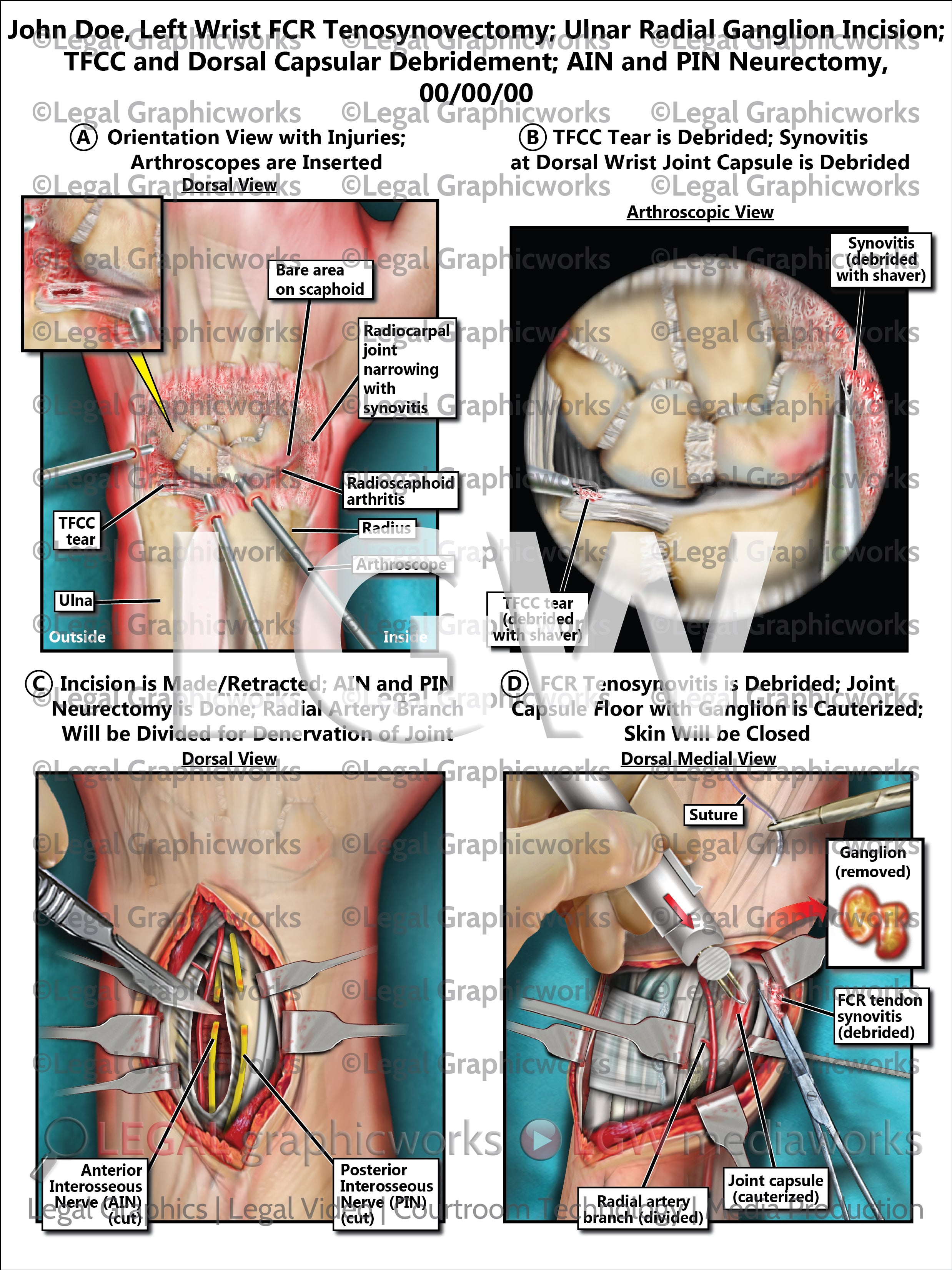 Left Wrist FCR Tenosynovectomy Ulnar Radial Ganglion Incision TFCC A left-wrist-fcr-tenosynovectomy-ulnar-radial-ganglion-incision-tfcc-a